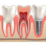 implantes dentales medellín