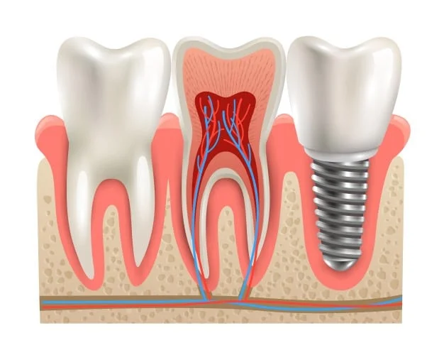 implantes dentales medellín