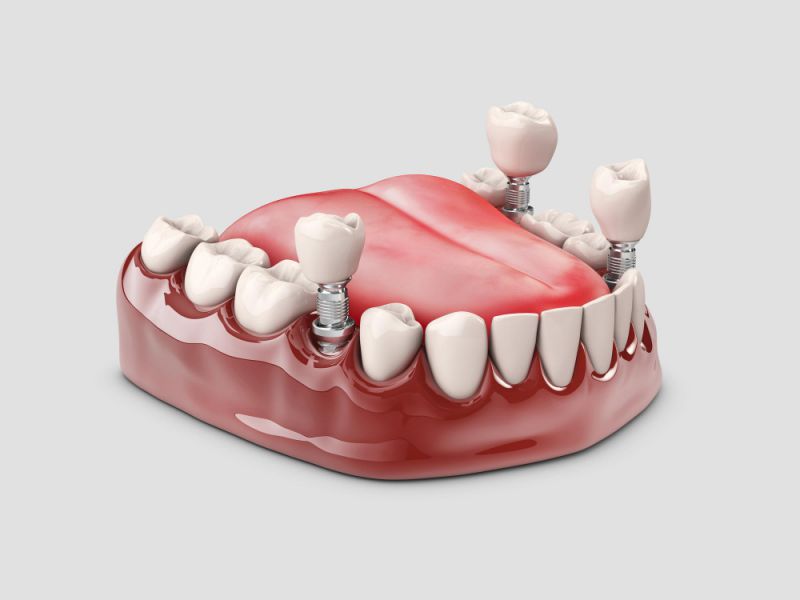 dental implants medellin